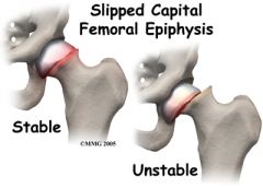 Femoral epiphysis slips with respect to the femur usually in a postero-inferior direction