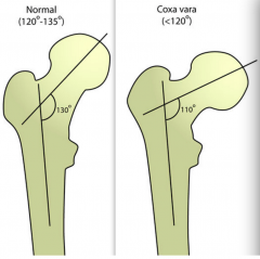 Avascular necrosis
Coxa vara 
Early osteoarthritis