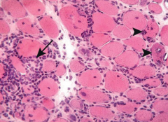 Inclusion Body Myositis (IBM)
- Endomysial infiltrates (CD8)
* Rimmed vacuoles
- Amyloid deposits
- Invasion of non-necrotic fibers
* Tubulofilamentous inclusions