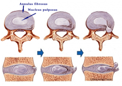 Nucleus pulposus prolapses through a rupture in the annulus