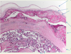 What is the condition? Labels each arrow (placental septum, chorionic villi, subchorionic fibrin with entrapped villi, wavefront of ploys starting to infiltrate, amnion). 