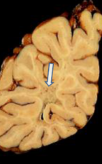 Gray discoloration of white matter; marked firmness

Severe demyelination with U fiber preservation