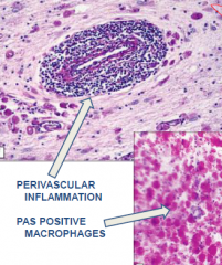 ******Pervascular inflammation and PAS positive macrophages