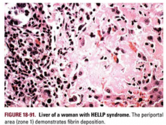 In HELLP syndrome, liver injury can progress to _______, hemorrhage, even liver ________. 


 


20% of patients with HELLP syndrome get _________; some get hepato-renal failure, some pulmonary edema and acute respiratory distress syndrom...