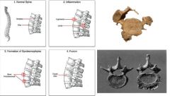 Degeneration of spinal column
Leaking disc fluid leads to osteophyte formation on vertebral bodies
May result in vertebral fusion
