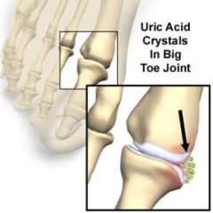 Medical condition caused by elevated levels of uric acid in blood
Uric acid crystallized and deposits in joints, tendons and surrounding tissues
Creates arthritic conditions, ultimately alteration of the shape of the bones