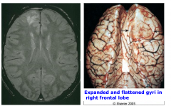 Astrocytoma, diffuse, WHO grade 2 MRI and gross brain. 

There is expanded and flattened gyri in the right frontal lobe
