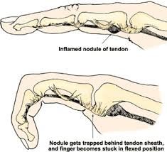 IMAGE.


HINT. is obvious.


Trigger finger is tenosynovitis of the finger flexors, especially the first. It's caused by repetition.