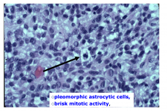 GBM - high power
- pleomorphic  astrocytic cells
- brisk mitotic activity
