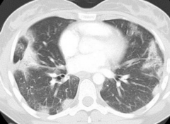 Infectious and non-infectious causes. Peripheral unilateral/bilateral patchy consolidation, often migratory. Subpleural/peribronchial distribution. Nodules, masses, ground-glass. May have bronchial wall thickening