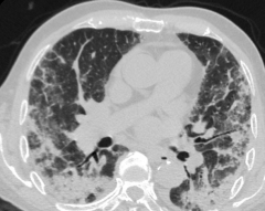 Reverse pulmonary oedema (peripheral).