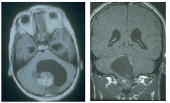 Pilocystic astrocytoma MRIs