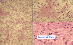 Biphasic Pattern: densely fibrillary (pilocytic) areas alternating with microcystic component