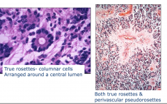 Ependymoma:Histology

True rosettes - columnar cells 
Arranged around a central lumen