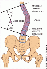Depends on individual. Rule of thumb – Cobb angle

< 25° – Observe
25°-40° – Brace
> 40° – Consider surgery