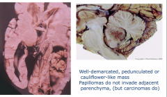 Choroid Plexus Papilloma
Well-demarcated, penduculated, or cauliflower mass
Papillomas do not invade adjacent parenchyma (but carcinomas do)
