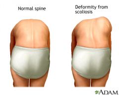 It tend to be compensated for thoracic bend by bending the lumbar spine.
Adam's forward bend eliminates this compensation