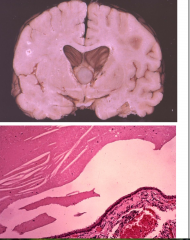 - Usually attached to roof of 3rd ventricle
- Intermittent obstruction of the foramen of Monro
Positional Headache
Think-walled cyst lined by cuboid/columnar epithelium