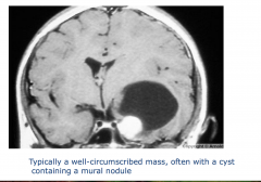 Ganglioglioma
-typically a well-circumscribed mass, often with a cyst containing a mural nodule