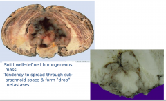 Medullolastoma
- solid well defined homogenous mass
- tendency to spread through sub-arachnoid space and form "drop"metastases