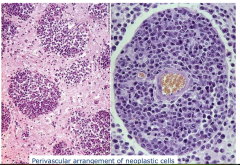 Primary CNS Lymphoma

- perivascular arrangement of neoplastic cells