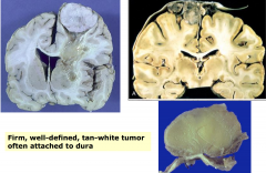 - Meningioma
- firm, well-defined, tan-white tumor often attached to dura