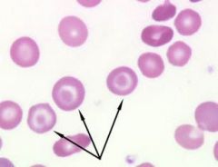 You see target cells on your blood smear. What does this imply?