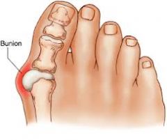 Lateral bending of big toe leaving a prominent head of the metatarsal bone which forms a bursa
over it while the skin becomes inflamed 