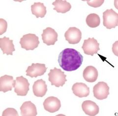 You see echinocytes on your blood smear. What does this mean?