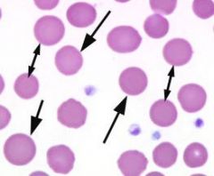 You see spherocytes on your blood smear. What does this imply?