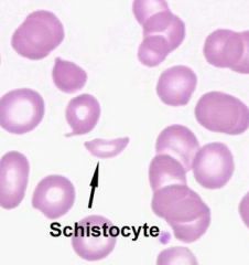You see schistocytes on your blood smear. What does this imply?