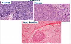 Meningioma, atypical and anaplastic features