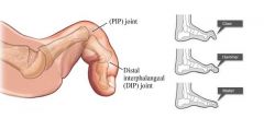 Inflammatory joint disease (eg RA) causing dorsal dislocation of the metatarso-phalangeal (MTP) joint and flexion of the PIP and DIP joints