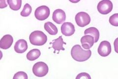 You see acanthocytes on your blood smear. What does this imply?