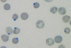 You see Heinz bodies on your blood smear. What does this indicate?