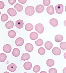 What is a Howell-Jolly body? What does it mean if you see them on a blood smear?