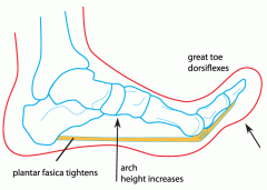 Complete failure of the foot to form an arch 
Windlass test (picture) – Dorsiflex the toes (or ask patient to stand on toes). Positive if still no arch. 