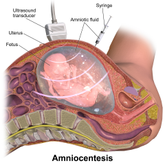 Amniocentesis (also referred to as amniotic fluid test or AFT) is a medical procedure used in prenatal diagnosis of chromosomal abnormalities and fetal infections, and also used for sex determination in which a small amount of amniotic flui...