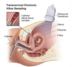 Chorionic villus sampling (CVS) is a form ofprenatal diagnosis to determine chromosomal or genetic disorders in the fetus. It entails sampling of the chorionic villus (placental tissue) and testing it for chromosomal abnormalities, usu...
