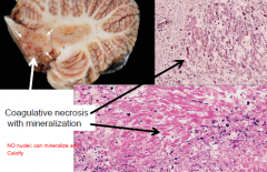 Disseminated necrotizing leukoencephalopathy

coagulative necrosis with axonal loss and mineralization