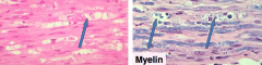 Axonal degeneration - digestion chambers (or myelin ovoids)