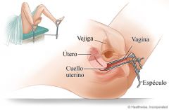 ESPÉ**** VAGINAL
Instrumento que consta de dos valvas que se introducen a través de orificio vaginal cerradas. Una vez que el espé**** está colocado en la vagina, las valvas se abren de forma que se facilita la exploración de la vagina y el c...