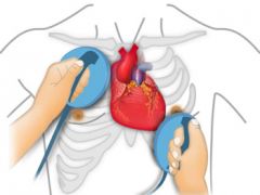 DESFIBRILADOR EXTERNO
Es un dispositivo mediante el cual podemos suministrar una descarga eléctrica al corazón (mediante unas placas o palas colocadas en el tórax del paciente) para poder revertir algunos tipos de arritmias (taquicardia o fibri...