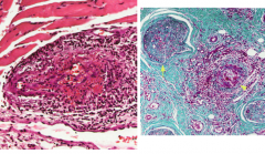 Vasculitis (Mononeuritis Multiplex)

Nerve biopsy shows:
- Inflammation of nerve
- Vascular necrosis
