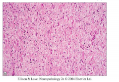 Hypocellular
Elongated spindle cells with wavy nuclei
Diffusely infiltrate adjacent nerve and soft tissue