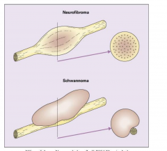 Neurofibroma vs. Schwannoma
