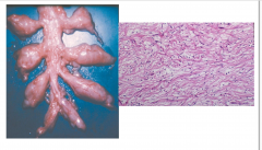 - Occurs almost exclusively in NF1
- Transformation of multiple fascicles of nerves into neurofibroma with preservation of anatomic configuration
- Typically affects larger nerves or a plexus
- High likelihood of malignant transformation