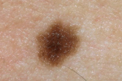1.  Smooth brown macules
2.  1-6 mm
3.  Can become compound or intradermal
4.  Small, well-nested on histo