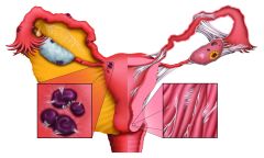 endometriosis
lạc nội mạc tử cung