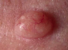 1.  Junctional activity has ceased
2.  All nevus cells in dermis
3.  Flesh-colored or pigmented, dome-shaped
4.  Usually symmetrical